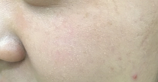 피부때문에 스트레스였는데 팩하니까 많이 좋아졌어요 ㅠ